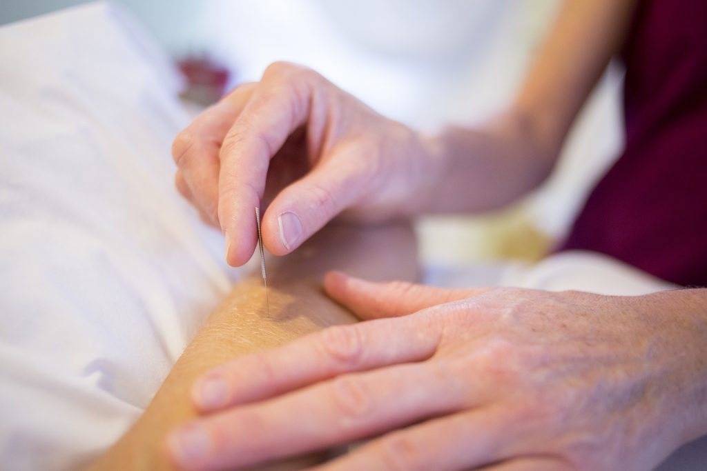Dłonie akupunkturzystki nakłuwające delikatnie igłą kończynę, prawdopodobnie rękę, pacjenta leżącego na łóżku na białych prześcieradłach