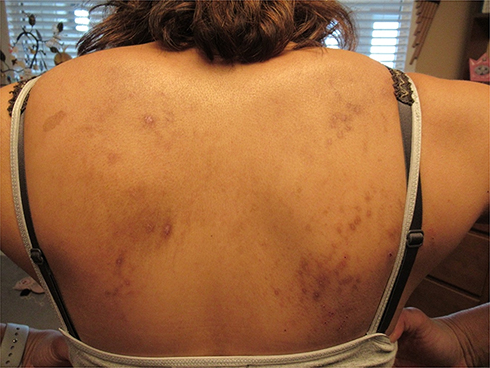 Plecy kobiety z podejrzeniem o chorobę Morgellonów - brązowe blizmy pokrywaja prawie całą powierzchnię pleców