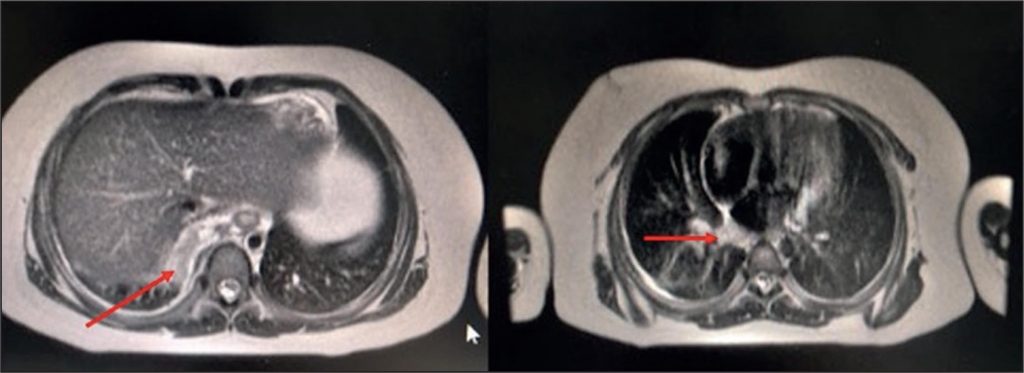 Obraz tomograficzny guza rzekomego w klatce piersiowej pacjenta