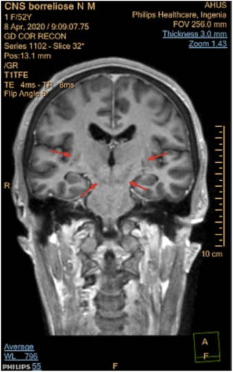 Skan mózgu z zaznaczonymi czerwonymi strzałkami obszarami zmienionymi chorobowo