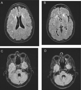 Cztery obrazy badania mózgu rezonansem magnetycznym