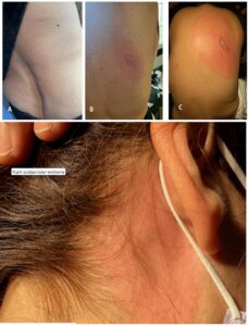 Kolaż zdjęć przedstawiających powiększający się rumień wędrujący na plecach oraz za uchem pacjentki