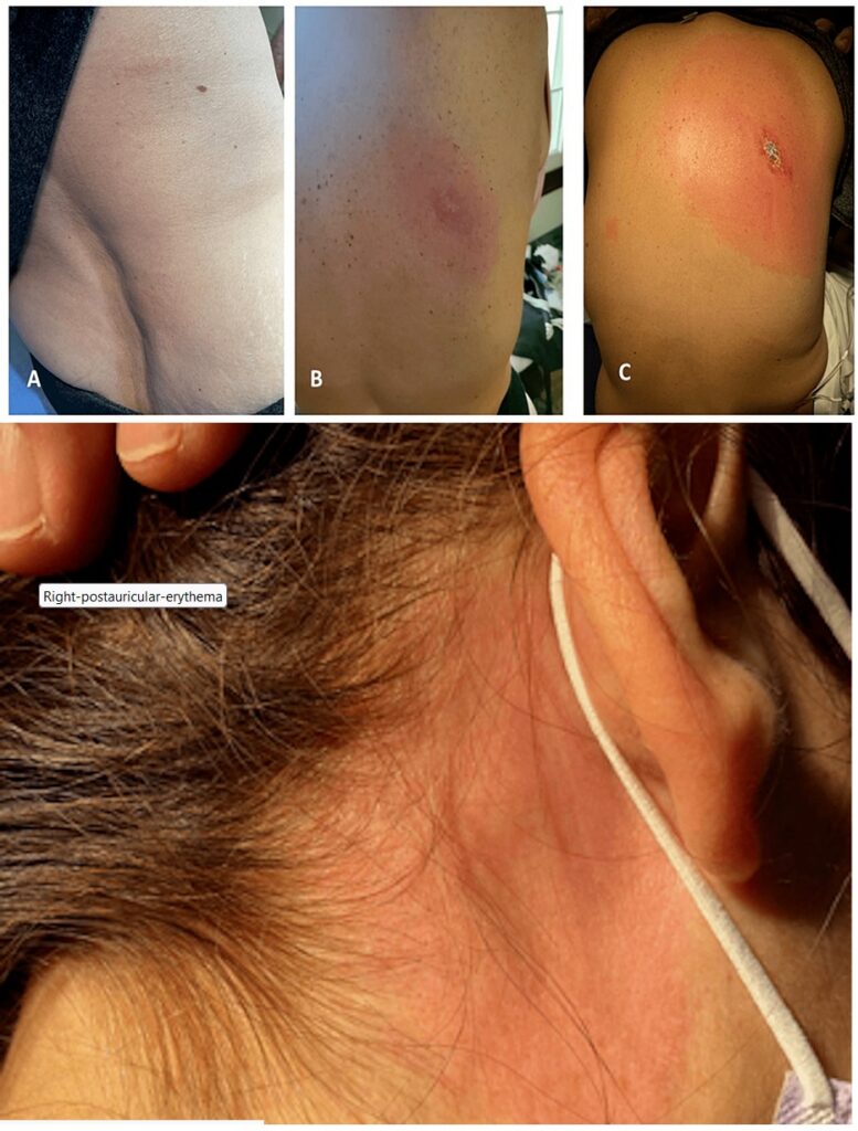 Kolaż zdjęć przedstawiających powiększający się rumień wędrujący na plecach oraz za uchem pacjentki